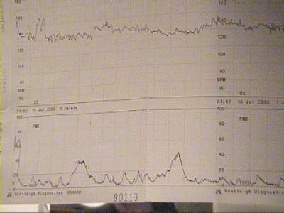 Babys heartbeat and Sams contractions